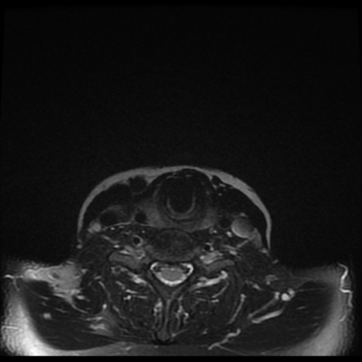 File:Adenoid cystic tumor of palate (Radiopaedia 46980-51519 Axial T2 fat sat 3).png