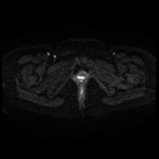 Adenoma malignum of cervix (Radiopaedia 66441-75705 Axial DWI 48).jpg