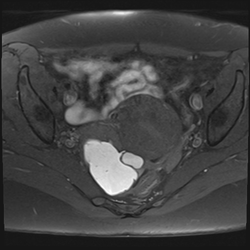 File:Adenomyosis and endometriotic cysts (Radiopaedia 82300-96367 Axial T1 fat sat 15).jpg