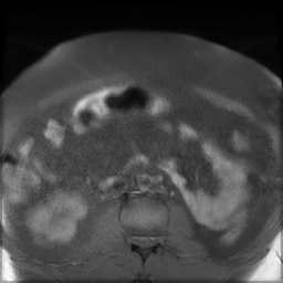 File:Adenomyosis within a didelphys uterus (Radiopaedia 70175-80215 Axial T1 fat sat 1).jpg