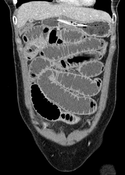 Adhesional small bowel obstruction (Radiopaedia 48397-53305 Coronal C+ portal venous phase 87).jpg