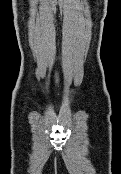 Adhesional small bowel obstruction (Radiopaedia 58900-66131 Coronal C+ portal venous phase 225).jpg
