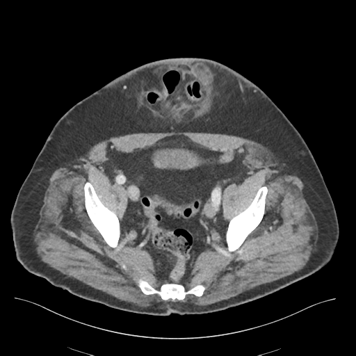 Adhesions within abdominal wall hernia (Radiopaedia 58283-65394 Axial C+ portal venous phase 70).png