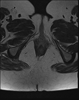 File:Adnexal multilocular cyst (O-RADS US 3- O-RADS MRI 3) (Radiopaedia 87426-103754 Axial T2 28).jpg