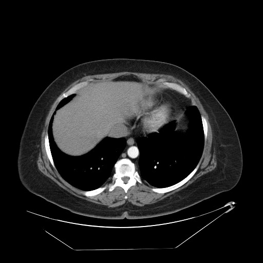 Adrenal angiosarcoma (Radiopaedia 81081-94671 Axial C+ arterial phase 7).jpg