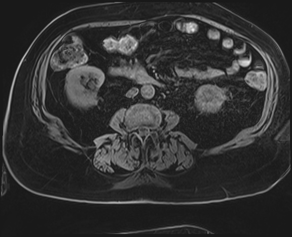 Adrenal cortical carcinoma (Radiopaedia 64017-72770 Axial T1 C+ fat sat 36).jpg