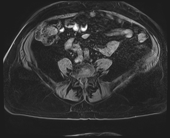 Adrenal cortical carcinoma (Radiopaedia 64017-72770 Axial T1 C+ fat sat 57).jpg
