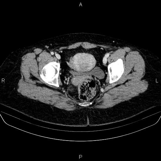 Adrenal cortical carcinoma (Radiopaedia 84882-100379 Axial C+ portal venous phase 89).jpg