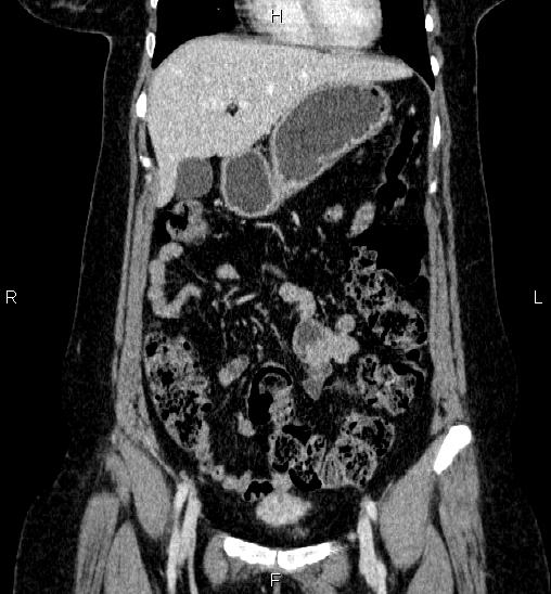 Adrenal cortical carcinoma (Radiopaedia 84882-100379 Coronal C+ portal venous phase 18).jpg
