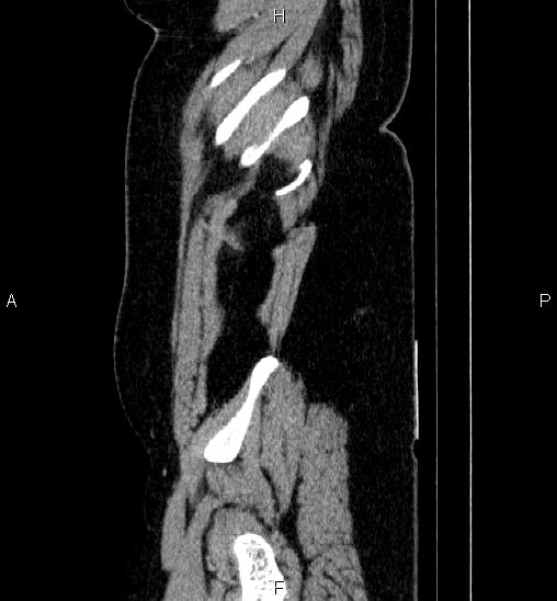 Adrenal cortical carcinoma (Radiopaedia 84882-100379 Sagittal C+ portal venous phase 8).jpg