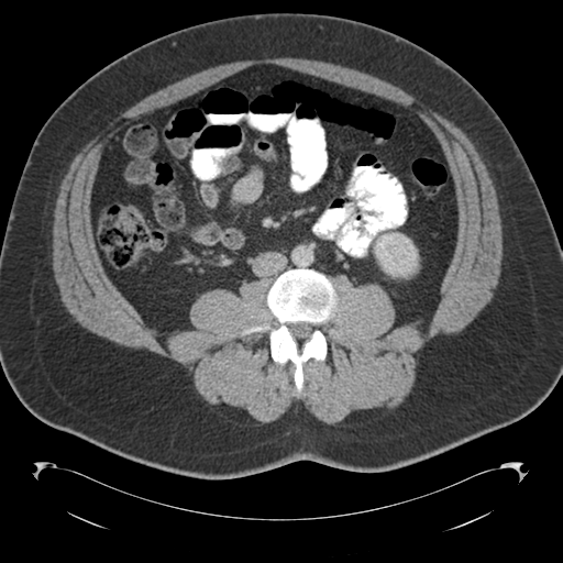 File:Adrenal cyst (Radiopaedia 45625-49776 Axial C+ portal venous phase 54).png