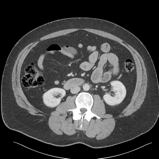 Adrenal cyst (Radiopaedia 45625-49777 Axial C+ portal venous phase 51).png