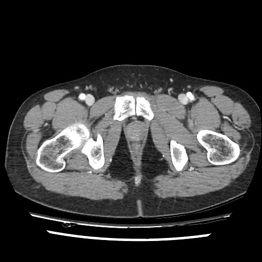 File:Adrenal gland trauma (Radiopaedia 81351-95078 Axial Dual bolus trauma C+ 122).jpg