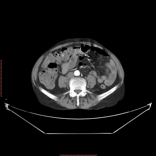 Adrenal hemangioma (Radiopaedia 68923-78668 Axial C+ arterial phase 46).jpg