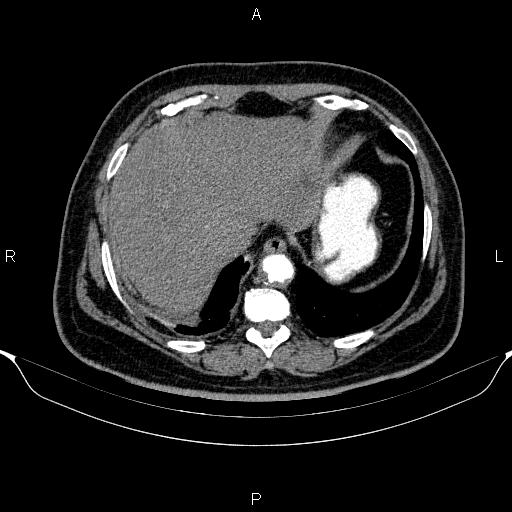 Adrenal hemorrhage (Radiopaedia 62622-70916 Axial C+ arterial phase 40).jpg
