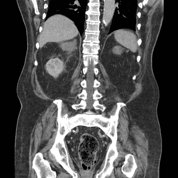 Adrenal lymphoma (Radiopaedia 84145-99415 Coronal C+ portal venous phase 65).jpg