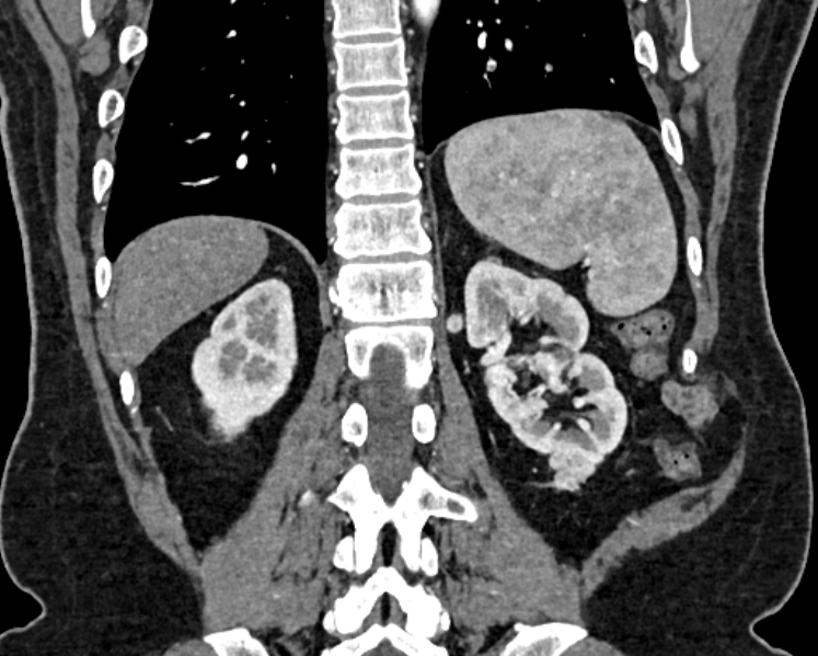 File:Adrenal metastases (Radiopaedia 73082-83791 Coronal C+ arterial phase 60).jpg