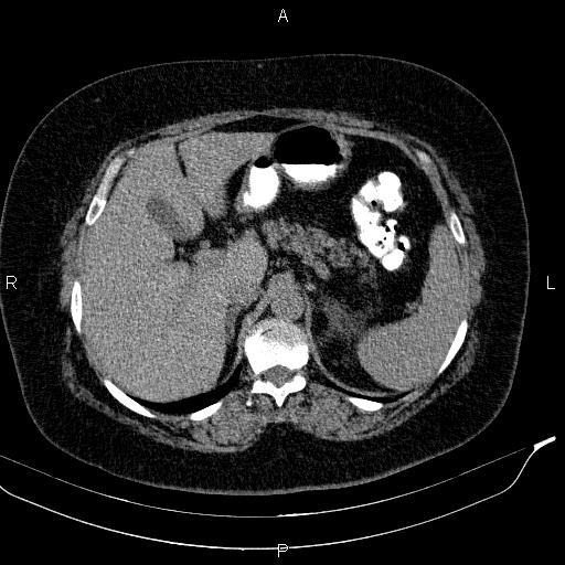 Adrenal myelolipoma (Radiopaedia 84319-99617 Axial With oral contrast 59).jpg