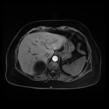 Adrenal myelolipoma - MRI (Radiopaedia 83249-97646 Axial T1 fat sat 12).jpg