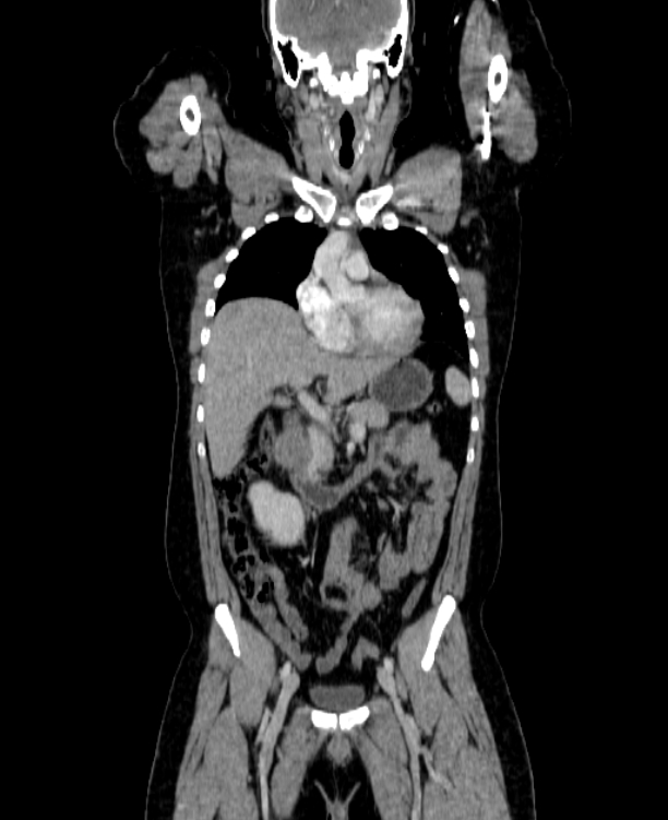 Adrenocortical carcinoma (Radiopaedia 80134-93438 Coronal C+ portal venous phase 68).jpg
