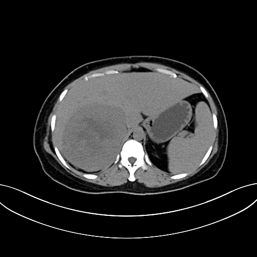Adrenocortical carcinoma (Radiopaedia 87281-103569 Axial non-contrast 22).jpg