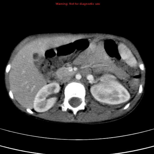 File:Adrenocortical carcinoma (Radiopaedia 9449-10131 Axial C+ portal venous phase 23).jpg