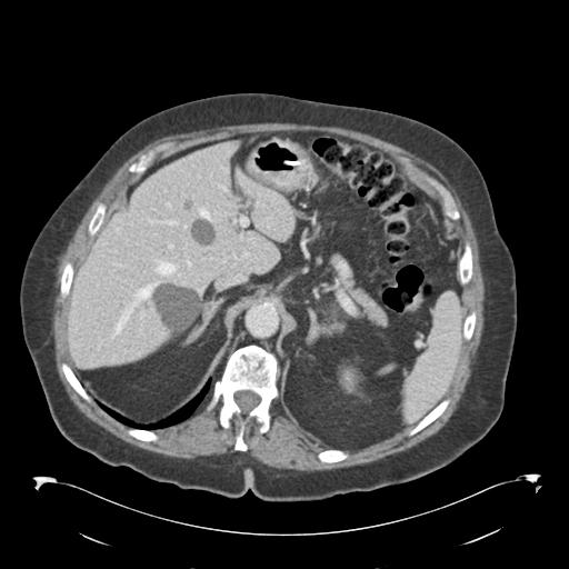 Adult ileal intussusception with secondary obstruction (Radiopaedia 30395-31051 Axial C+ portal venous phase 17).jpg