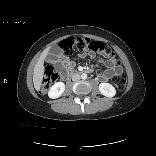 Adult transient intestinal intussusception (Radiopaedia 34853-36310 Axial C+ portal venous phase 36).jpg