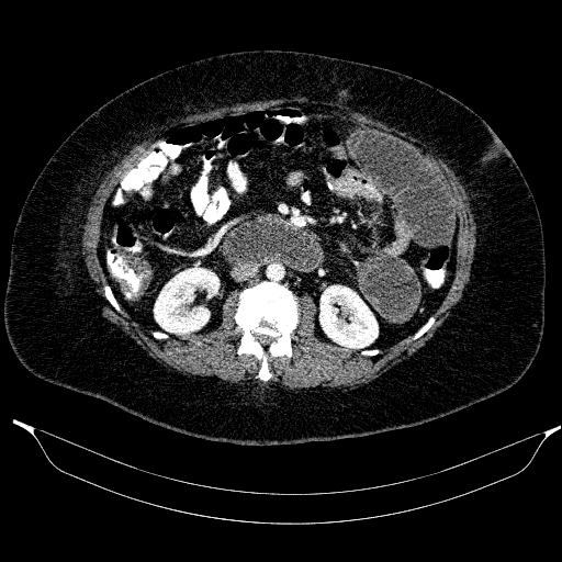 Afferent loop syndrome - secondary to incarcerated trocar site hernia (Radiopaedia 82959-97305 Axial C+ portal venous phase 108).jpg