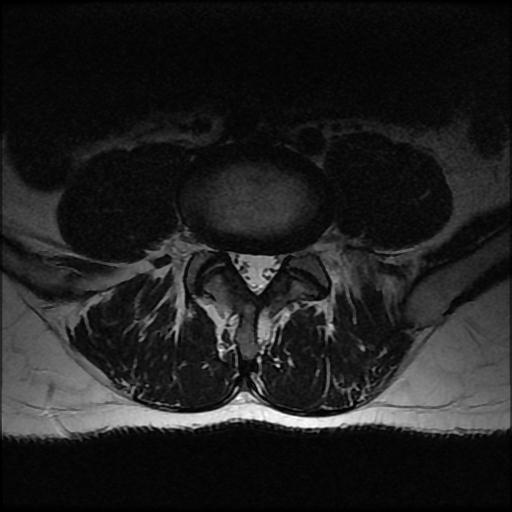 File:Aggressive vertebral hemangioma with pathological fracture (Radiopaedia 69528-79411 Axial T2 5).jpg