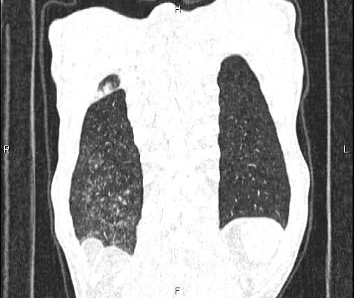 File:Air bronchogram in pneumonia (Radiopaedia 85719-101512 Coronal lung window 54).jpg