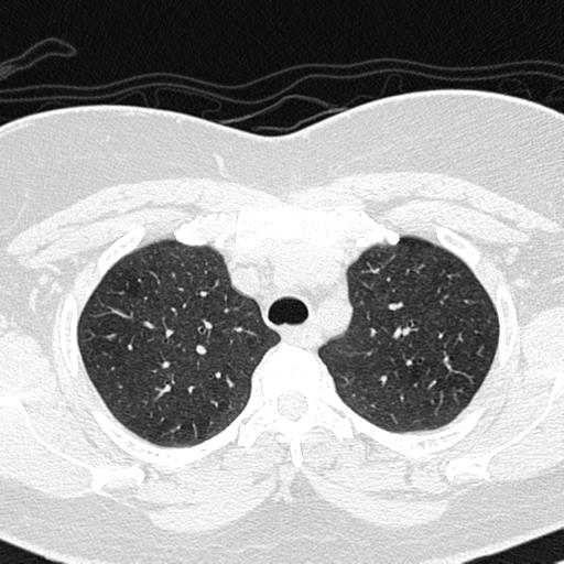 Air trapping in small airway disease (Radiopaedia 61685-69694 Axial lung window 39).jpg