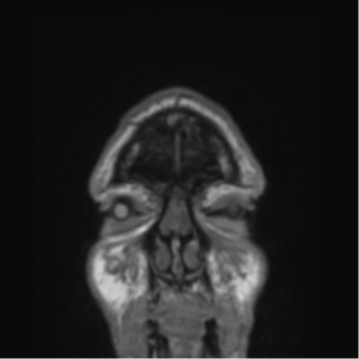 File:Alzheimer's disease- with Gerstmann syndrome and dressing apraxia (Radiopaedia 54882-61150 Coronal T1 88).png