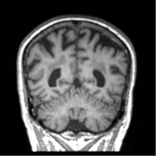 Alzheimer disease and cerebral amyloid angiopathy (Radiopaedia 64234-73011 Coronal T1 13).png
