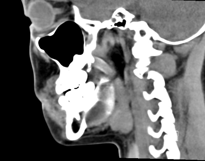 File:Ameloblastoma (Radiopaedia 26645-26793 Sagittal C+ delayed 13).jpg