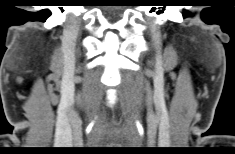 Ameloblastoma (Radiopaedia 33677-34806 Coronal non-contrast 45).png