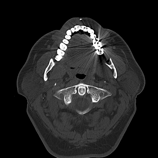 Ameloblastoma (Radiopaedia 38520-40623 Axial bone window 25).png