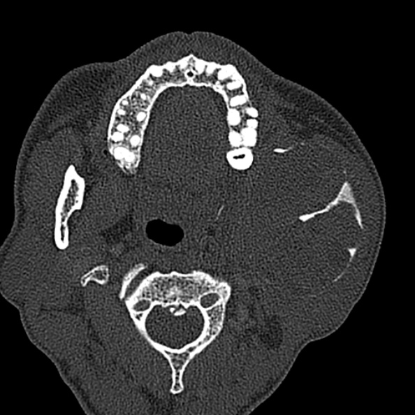 Ameloblastoma (Radiopaedia 51921-57766 Axial bone window 96).jpg