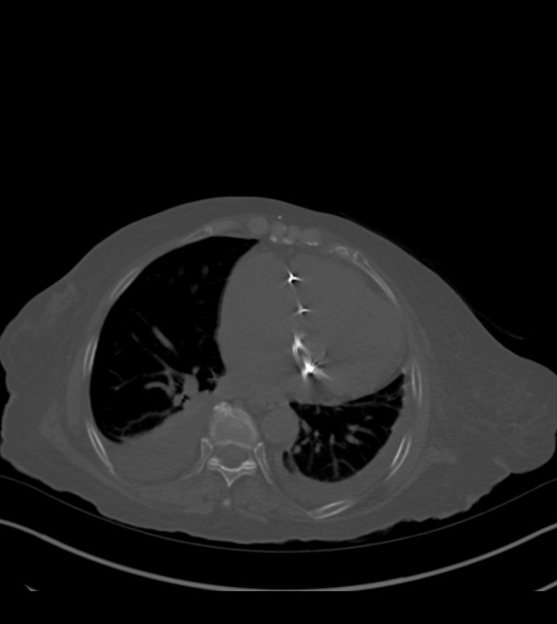 Amiodarone deposition in the liver (Radiopaedia 77587-89780 Axial bone window 55).jpg