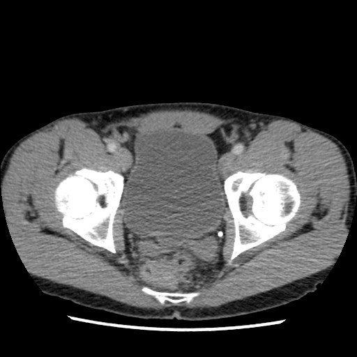 Amoebic liver abscesses (Radiopaedia 55536-62009 A 82).jpg
