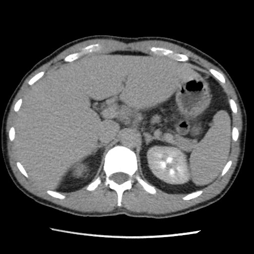 Amoebic liver abscesses (Radiopaedia 55536-62009 Axial C+ delayed 27).jpg