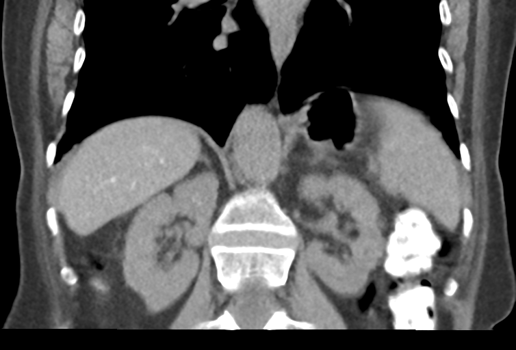 Ampullary adenocarcinoma (Radiopaedia 34013-35241 Coronal 33).png