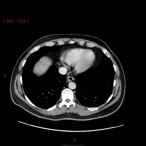 File:Ampullary carcinoma (Radiopaedia 56396-63056 C 10).jpg