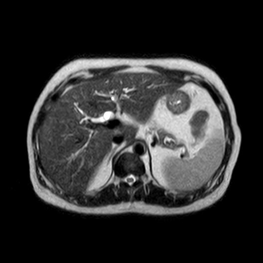 File:Ampullary tumor (Radiopaedia 27294-27479 T2 20).jpg