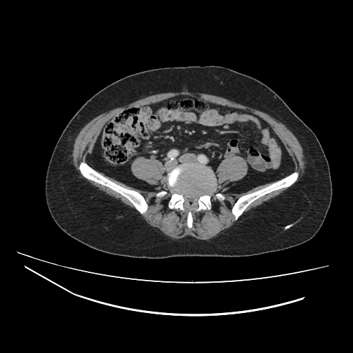 Ampullary tumor (Radiopaedia 60333-67998 A 57).jpg