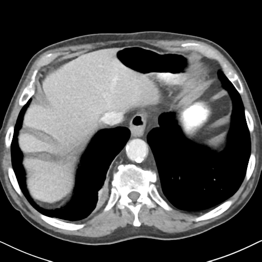 File:Amyand hernia (Radiopaedia 39300-41547 A 7).png
