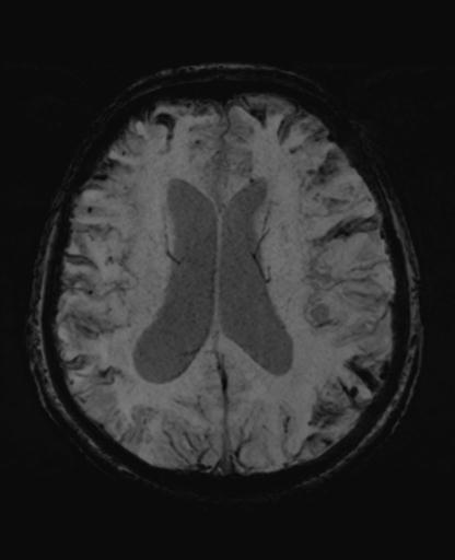 File:Amyloid angiopathy with inflammation (Radiopaedia 30360-31002 Axial SWI MIP 37).jpg