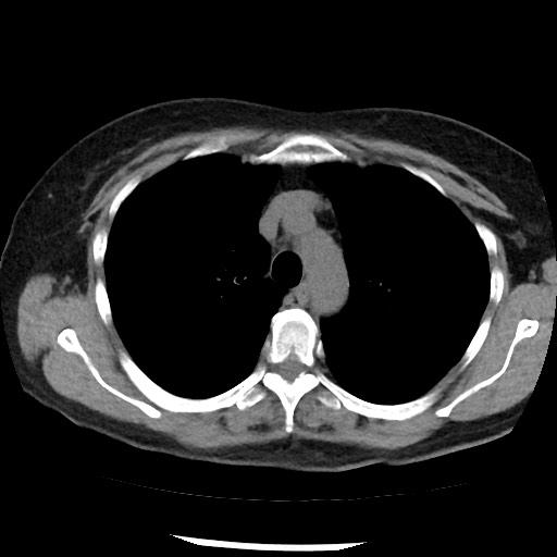 Amyloidosis - bronchial and diffuse nodular pulmonary involvement (Radiopaedia 60156-67744 Axial non-contrast 18).jpg