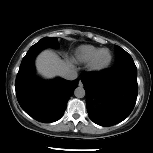 Amyloidosis - bronchial and diffuse nodular pulmonary involvement (Radiopaedia 60156-67744 Axial non-contrast 45).jpg