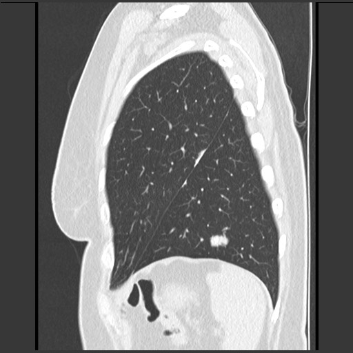 Amyloidosis - bronchial and diffuse nodular pulmonary involvement (Radiopaedia 60156-67744 F 47).jpg